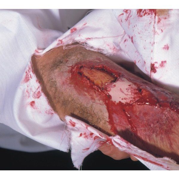 Kryolan open botbreuk